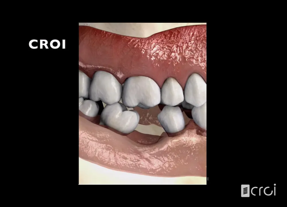Extrusión dentaria