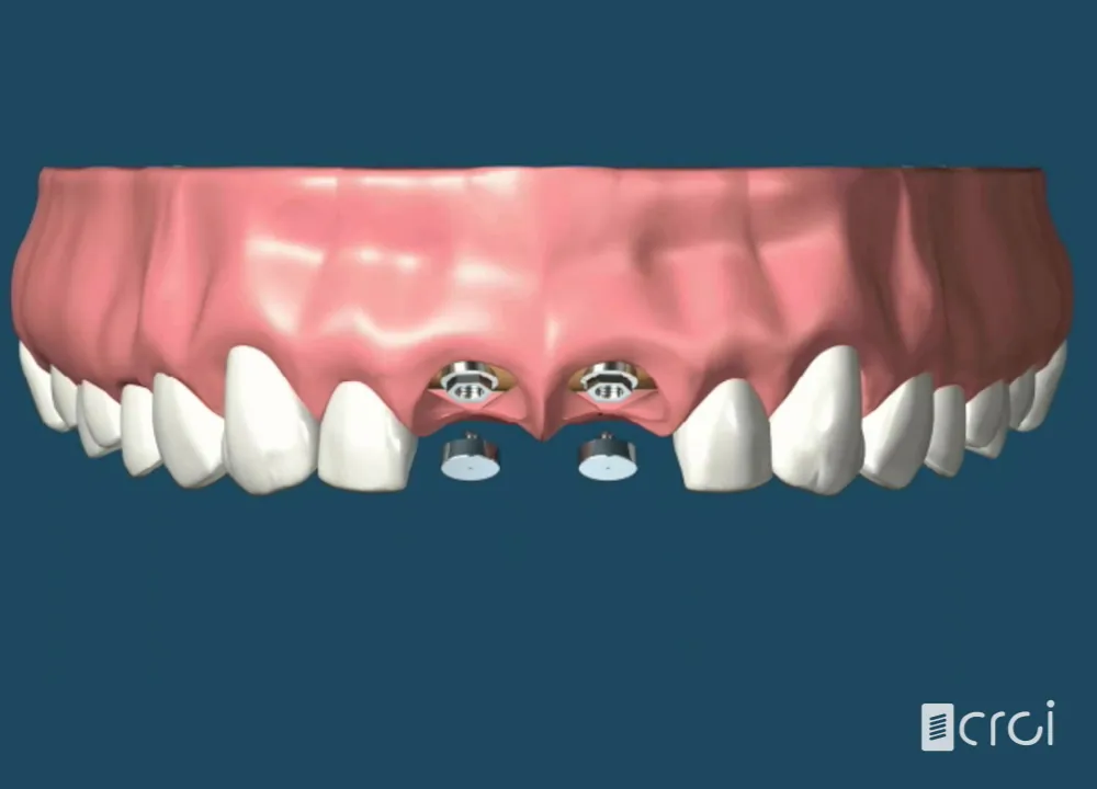 Implantes inmediatos anteriores