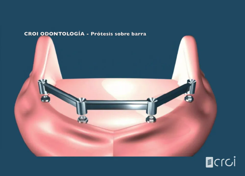 Prótesis sobre barra
